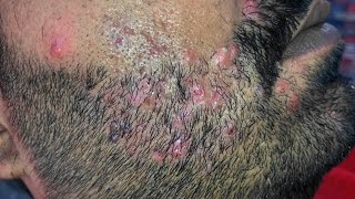 Infected Pimples Medication Stridex Blackheads Skincare Blackheads removal video [upl. by Kieffer213]