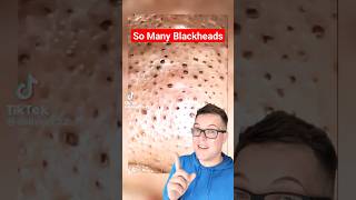 😲Most Blackheads I Have Ever Seen  BLACKHEAD REMOVAL shorts [upl. by Olgnaed368]