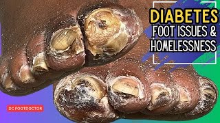 Diabetes Foot Issues and Homelessness [upl. by Kaspar]