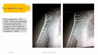 Humerus shaft fx with associated radial nerve palsy [upl. by Adihaj]