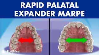 Rapid PALATAL expander MARPE  This ORTHODONTIC device can EXPAND the PALATE in adults© [upl. by Tolley355]