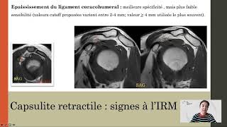 La capsule rétractile lésions du LCB et omarthrose [upl. by Guildroy]