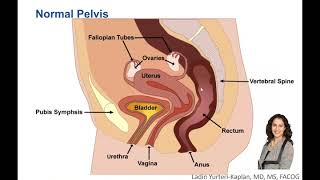 What is Uterine Prolapse and How is it Treated [upl. by Mickey947]