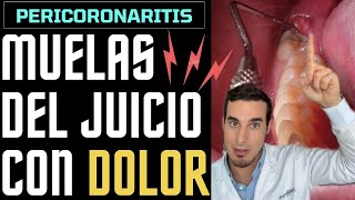 MUELA del JUICIO SALIENDO con dolor e inflamada  Así se ve una PERICORONARITIS [upl. by Hefter]