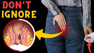 Top 10 Ways to Treatment Hemorrhoids [upl. by Ardelis]