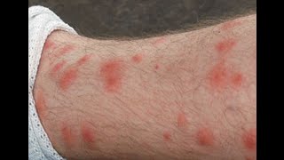 HOW TO  Get Rid of Chigger Bites and Stop Itching Naturally [upl. by Enair]