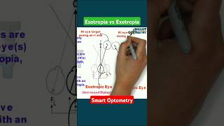 Esotropia Vs Exotropia optometry optometrist optometrists strabismus esotropia exotropia bsv [upl. by Ludewig673]