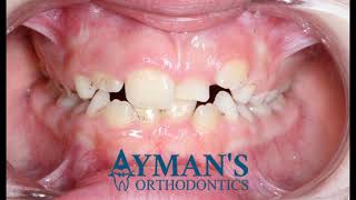 Orthodontic treatment of impacted central incisor [upl. by Hayilaa]