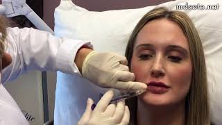 Juvéderm and Vollure Lip Injections with Doctor Cynthia Coté [upl. by Mercy256]