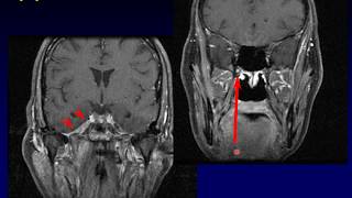 Imaging of the Nasopharynx [upl. by Becky]