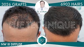 Hair Graft Technique FUE  3026 6903 Hairs  Dr de Freitas [upl. by Adah]