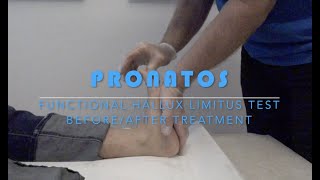 FUNCTIONAL HALLUX LIMITUS TEST BEFORE AND AFTER TREATMENT [upl. by Danit]