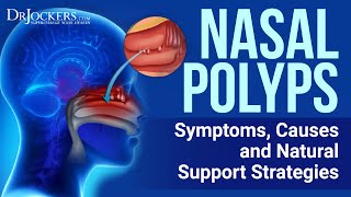 Top 12 Natural Remedies for Nasal Polyps [upl. by Donelle112]