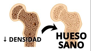 COMO GANAR DENSIDAD OSEA Y PREVENIR OSTEOPOROSIS EN 3 PASOS [upl. by Kattie]