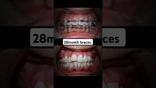 28 month braces 😱braces orthodontist dentist allaboutbraces dentaltreatment [upl. by Judie934]