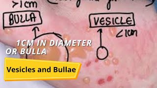 Vesicles and Bullae [upl. by Lerim561]