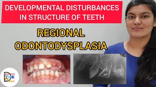 REGIONAL ODONTODYSPLASIA GHOST TEETH  DEVELOPMENTAL DISTURBANCES IN STRUCTURE OF TEETH [upl. by Nilorac344]