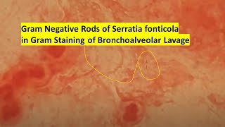 Gram Negative Rods of Serratia fonticola in Gram Staining of Bronchoalveolar Lavage [upl. by Ntsyrk]