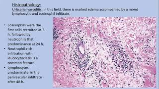 Lecture86 Urticarial Vasculitis Rooks chapter 44 [upl. by Annauqahs]