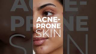 AcneProne Skin Care Routine5 easy Tips to followshorts acnetreatment acnetipsskincareroutine [upl. by Assanav]