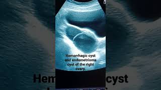 Ovarian Hemorrhagic cyst and endometrioma cyst in patient with irregular bleedingperiod [upl. by Curr]