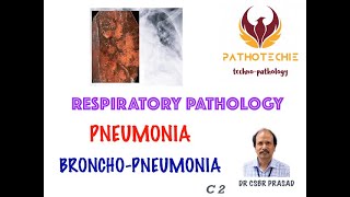 Pneumonia  Bronchopneumonia [upl. by Nos]