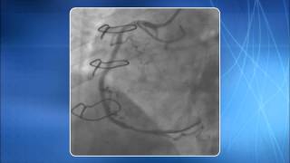 Chapter 6 Cannulation of the Coronary Ostia [upl. by Akram]