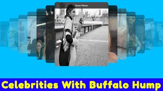 Celebrities With Buffalo Hump [upl. by Nosral816]