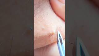 Plucking Chin Hair  Female Beard  PCOS Hair satisfying [upl. by Gaul168]