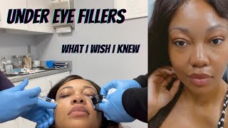 What I wish I knew before getting Under Eye filler [upl. by Atires708]