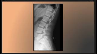 Short Case Discussion  Grade I anterolisthesis and spondylolisthesis [upl. by Ecinahc]