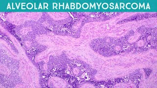 Alveolar rhabdomyosarcoma explained in 5 minutes pediatric pathology USMLE rare disease [upl. by Rolan376]