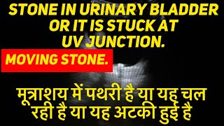 Moving stone in urinary bladder or it is stuck at UV junction  calculus urinarybladder [upl. by Fulvi]