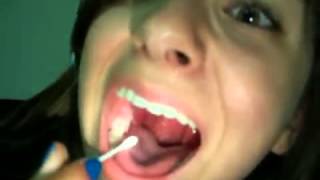 Gnarly Tonsil Stone Removal THE SEQUEL  How To ManageGet Rid Of Tonsil Stones [upl. by Cerell]