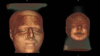 Lissencephal Brain VS normal Brain using MRI [upl. by Male]