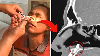 Doctors Find Whats Growing Inside his NOSE After Man Has Intense Itch For Years [upl. by Adamis]