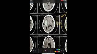 CT BRAIN  PUTAMEN BLEED  BASAL GANGLIA HEMORRHAGE TYPICAL HYPERTENSIVE BLEED HEMORRHAGE [upl. by Benito]