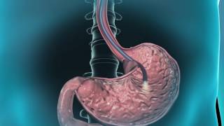 Learn about gastroscopy [upl. by Ynotna]