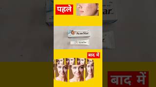 Acnestar cream कालेपन को जड़ से खत्म kare beauty healthyglow skincare cream [upl. by Henigman]