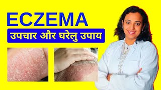 Eczema Treatment  Eczema Ka Ilaj Home Remedies Aur Precautions [upl. by Ahseiuqal]