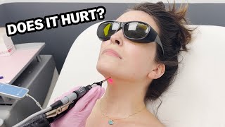 My Journey With Laser Hair Removal The Truth [upl. by Sheedy]