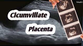 Circumvallate placenta on ultrasoundplacental abnormalities [upl. by Viddah]