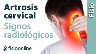 Artrosis cervical  Signos radiológicos [upl. by Itnava521]