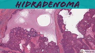 Nodular Hidradenoma Acrospiroma 5Minute Pathology Pearls [upl. by Tnomyar]