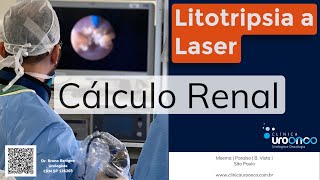 Por que fazer Litotripsia a Laser para o tratamento do cálculo Renal Pedra no Rim Entenda [upl. by Shetrit]