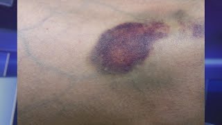 Do You Bruise Easily Learn How to Prevent and Fade Them [upl. by Yerffoeg]