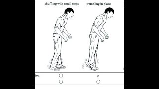 Parkinsonian Gait Shuffling Gait Propulsive gait seen in Parkinsons Disease Patients [upl. by Sivla]