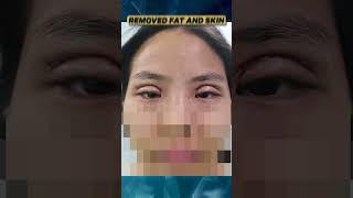 Lid Crease Creation Or Asian Blepharoplasty [upl. by Kahlil551]