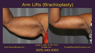 Arm Lift Brachioplasty San Francisco Bay Area [upl. by Schwartz]