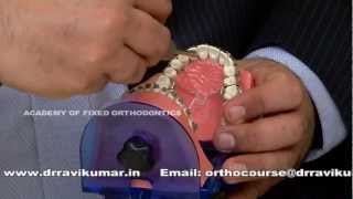 Orthodontic Mini Screw Implant TAD Course [upl. by Alvy]